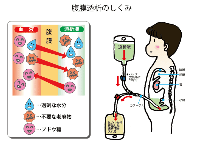 腹膜透析のしくみ