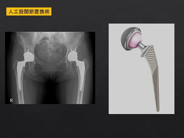 人工股関節置換術