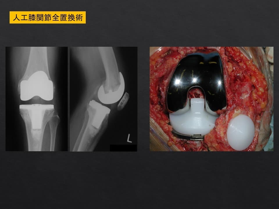 人工膝関節全置換術