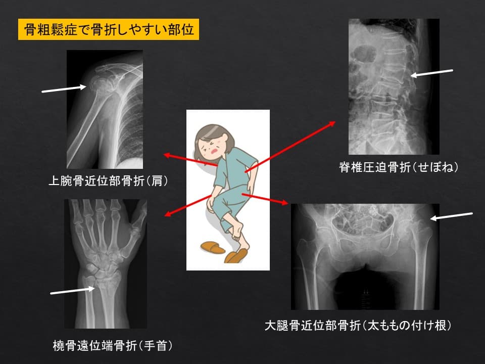 骨粗鬆症